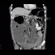 Colorectal cancer, carcinoma of descendens, ileus: CT - Computed tomography